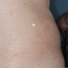 A photo of a patient's back showing atopic dermatitis after 8 weeks of treatment with OPZELURA and a resulting IGA score of 1