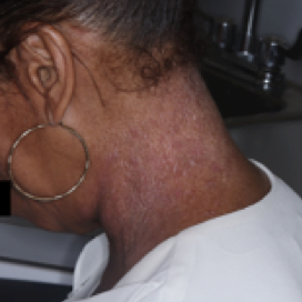 A photo of a patient's neck showing atopic dermatitis before treatment with OPZELURA that has an IGA of 3