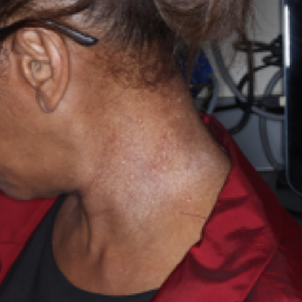 A photo of a patient's neck showing atopic dermatitis after 2 weeks of treatment with OPZELURA and a resulting IGA score of 2