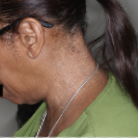 A photo of a patient's neck showing atopic dermatitis after 8 weeks of treatment with OPZELURA and a resulting IGA score of 1