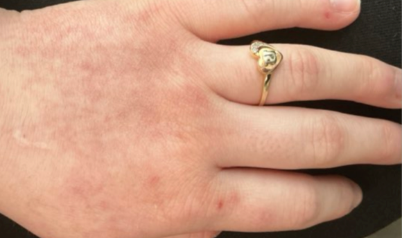 A close-up of the same part of the hand after 4 weeks of treatment with OPZELURA.