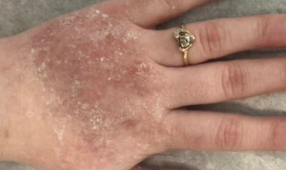 A close-up of a dorsal hand showing an atopic dermatitis lesion before treatment with OPZELURA.