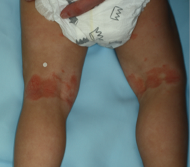 Clinical trial patient before OPZELURA, 2-year-old male, back of knee