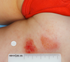 Clinical trial patient before OPZELURA, 3-year-old female, inner thigh/buttocks