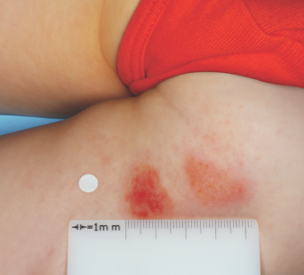 Clinical trial patient before OPZELURA, 3-year-old female, inner thigh/buttocks