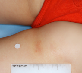 Clinical trial patient after 4 weeks of OPZELURA treatment, 3-year-old female, inner thigh/buttocks