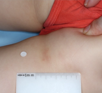 Clinical trial patient after 4 weeks of OPZELURA treatment, 3-year-old female, inner thigh/buttocks