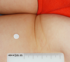 Clinical trial patient after 8 weeks of OPZELURA treatment, 3-year-old female, inner thigh/buttocks