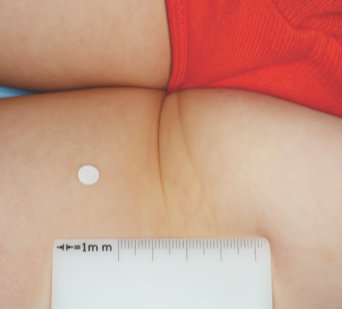 Clinical trial patient after 8 weeks of OPZELURA treatment, 3-year-old female, inner thigh/buttocks