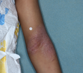 Clinical trial patient before OPZELURA, 5-year-old male, arm