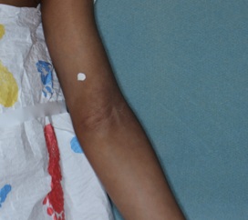 Clinical trial patient after 2 weeks of OPZELURA treatment, 5-year-old male, arm