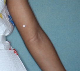 Clinical trial patient after 8 weeks of OPZELURA treatment, 5-year-old male, arm