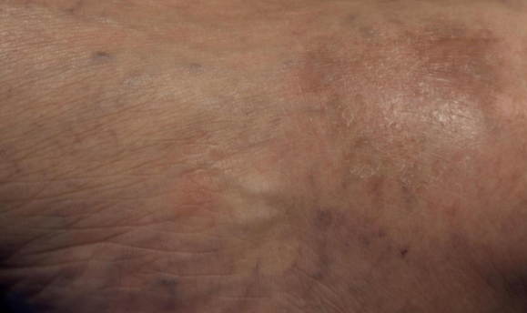 A close-up of the same part of the ankle after 2 weeks of treatment with OPZELURA and a resulting IGA score of 1