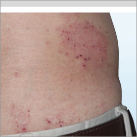 A photo of a patient's back showing atopic dermatitis before treatment with OPZELURA that has an IGA of 3