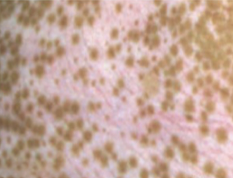 Perifollicular pattern
