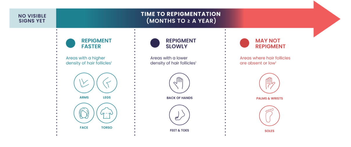 Time to repigmentation chart. Repigment faster: arms, legs, face, and torso. Repigment slowly: Back of hands and feet and toes. May not repigment: palms and wrists and soles.