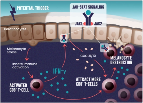 The JAK-STAT pathway drives the inflammatory cycle in vitiligo