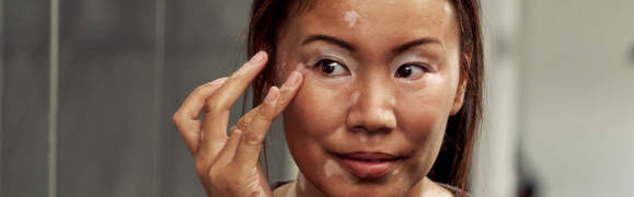 A person showing symptoms of nonsegmental vitiligo