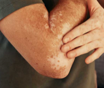 A person showing symptoms of nonsegmental vitiligo