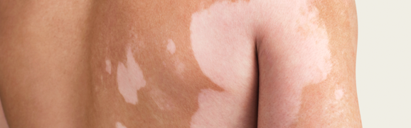 A person showing symptoms of nonsegmental vitiligo