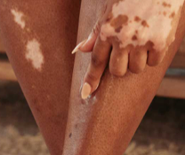 A person showing symptoms of nonsegmental vitiligo