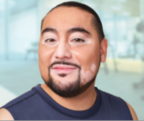 A person showing symptoms of nonsegmental vitiligo