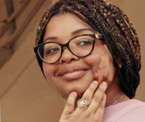 A person showing symptoms of nonsegmental vitiligo