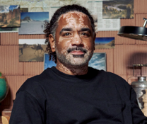 A person showing symptoms of nonsegmental vitiligo