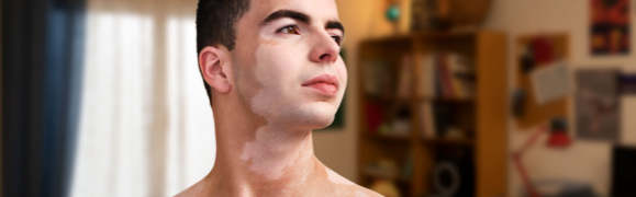 A person showing symptoms of nonsegmental vitiligo