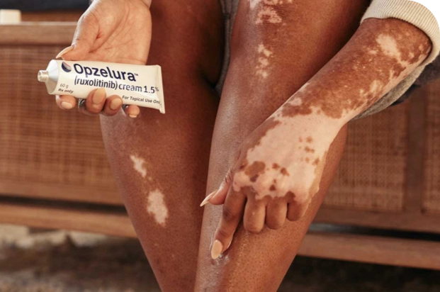 A person showing symptoms of nonsegmental vitiligo