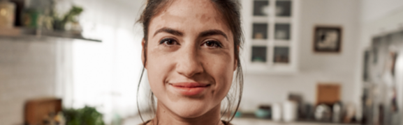 A person showing symptoms of nonsegmental vitiligo
