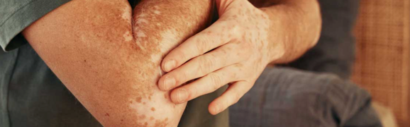 A person showing symptoms of nonsegmental vitiligo