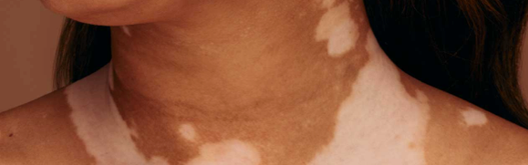 A person showing symptoms of nonsegmental vitiligo