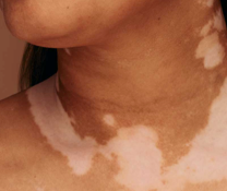 A person showing symptoms of nonsegmental vitiligo
