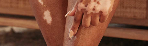 A person showing symptoms of nonsegmental vitiligo