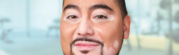 A person showing symptoms of nonsegmental vitiligo