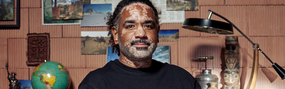 A person showing symptoms of nonsegmental vitiligo