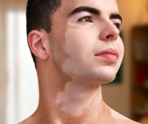 A person showing symptoms of nonsegmental vitiligo