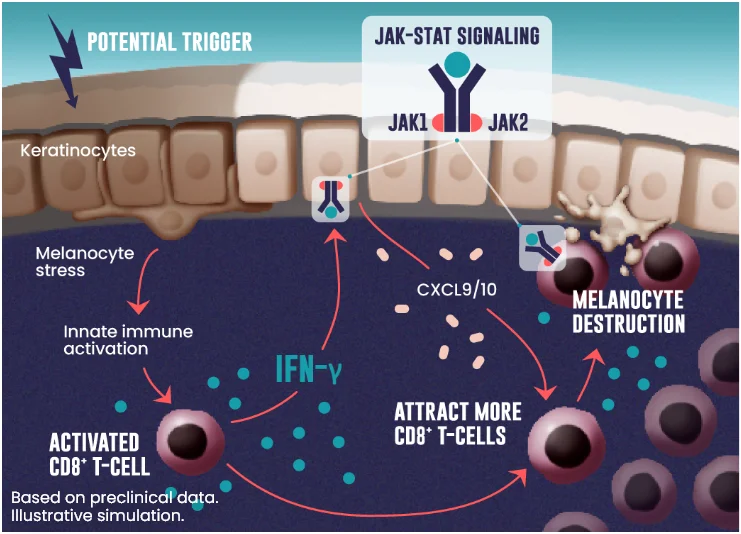 The JAK-STAT pathway is thought to drive the inflammatory cycle in vitiligo